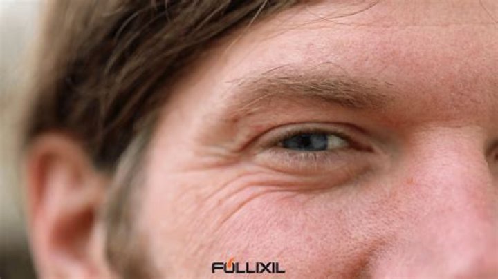 Does minoxidil cause wrinkles?