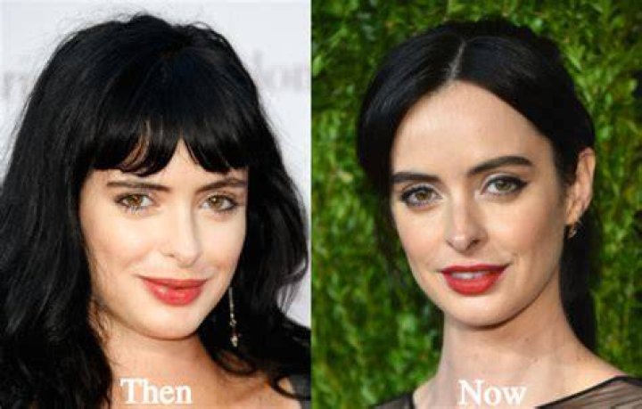 Krysten Ritter Plastic Surgery
