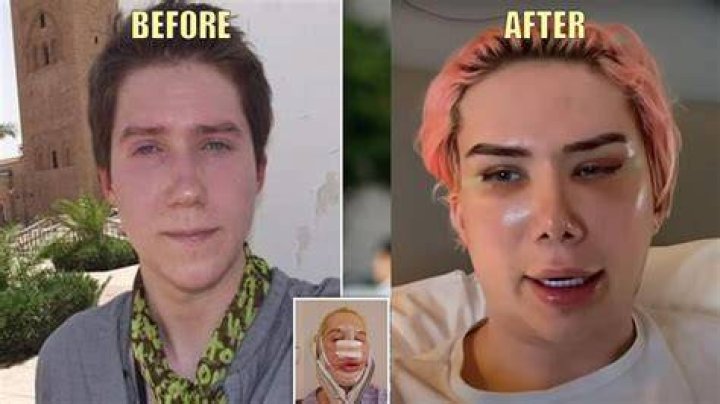 Ms London Before Surgery