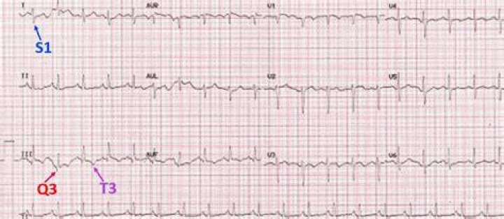 What is s1q3t3 in ECG?